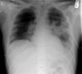 XR chest - pneumonia with abscess and caverns - d0.jpg
