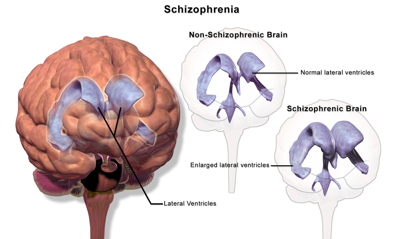 Soubor:Schizophrenia (Illustration).png
